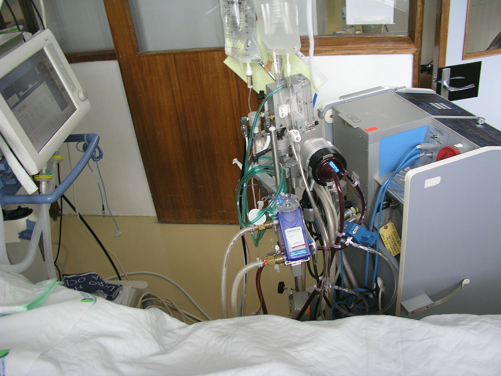 A patient connected to an ECMO machine (illustrative)